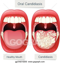 EPS Vector - Human mouth anatomy oral candidiasis. Stock ...