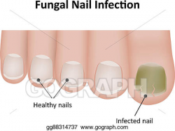 Stock Illustration - Fungal nail infection diagram. Clipart ...