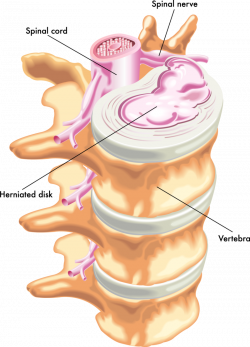 Back Pain | Herniated Discs vs. Bulging Discs | The Center