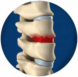 Bone Spurs | Symptoms & Advanced Spine Care Options