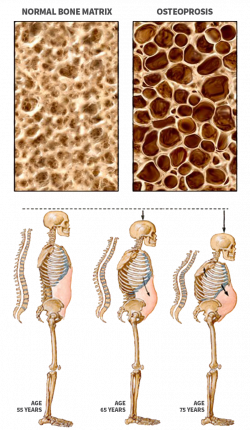 Osteoporosis - Endocrinology of Central PA