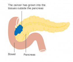 Pancreatic cancer - Wikiwand