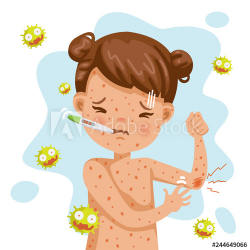 German Rash fever of rubella. A sick little girl with fever ...