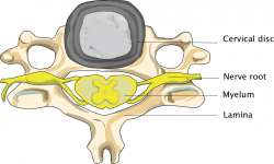 Diagnosis of cervical spinal stenosis - Conditions - Dr Schröder