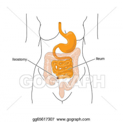 EPS Vector - Stomach, gut, bowel, ileostomy. Stock Clipart ...