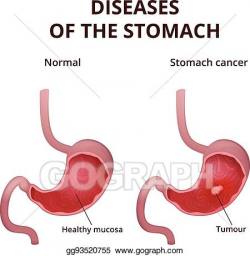 Vector Stock - Anatomy of the human stomach. Clipart ...