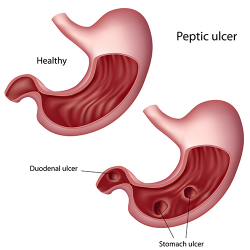Duodenal ulcer | healthdirect