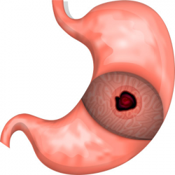 Free Cliparts Stomach Ulcer, Download Free Clip Art, Free ...