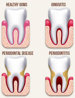 What Is Gum Disease? The California Society of Periodontists