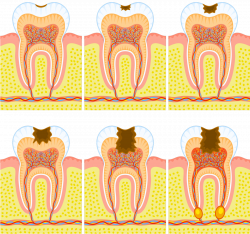 Genetic Factors for Tooth Decay | Markham NS Dental