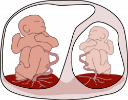 Twin-to-twin transfusion syndrome - Wikipedia