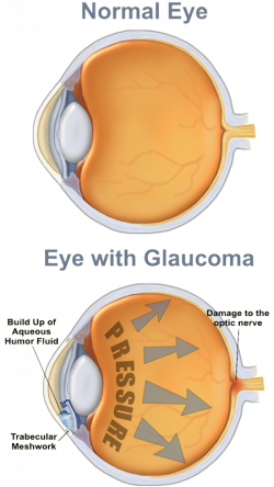 Eye Health | Edwards & Walker Opticians